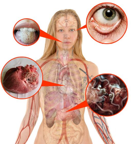 Parásitos y gusanos en el cuerpo humano